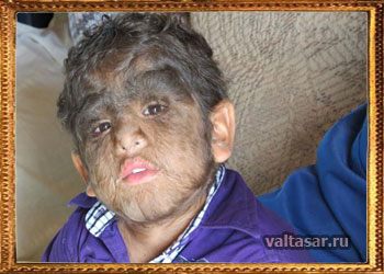 болезнь гипертрихоз