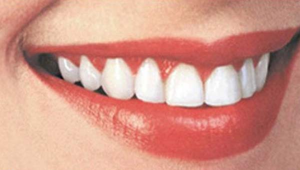 Голливудская улыбка