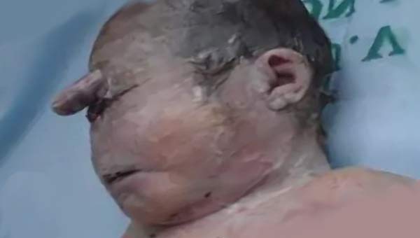 циклопия у ребенка