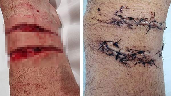 следы от укуса гигантской змеи