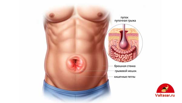 грыжа у человека
